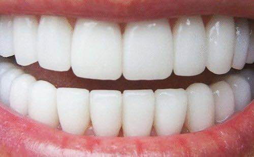 牙齒美白